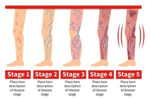 Варикоз Вен На Ногах Стадии