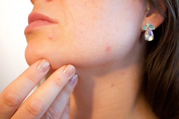 Acne Treatment Using Laser Therapy
