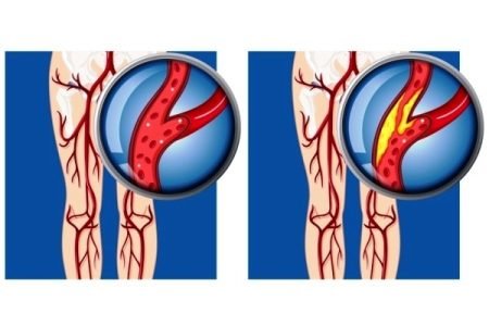 Artery in Leg: Type, Blocked Artery, Vascular Problems