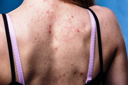 Back Acne - Learn About Basics
