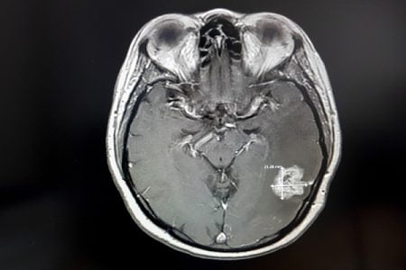How Common Are Brain Tumors?