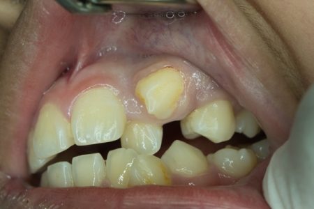 Extra Teeth Growing Out of Gums