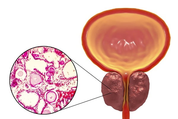 How Is Enlarged Prostate (Benign Prostate Hyperplasia) Diagnosed?