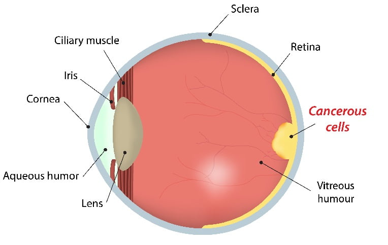 Unilateral vs Bilateral Retinoblastoma