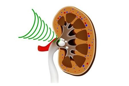 Shock Wave Lithotripsy (SWL)