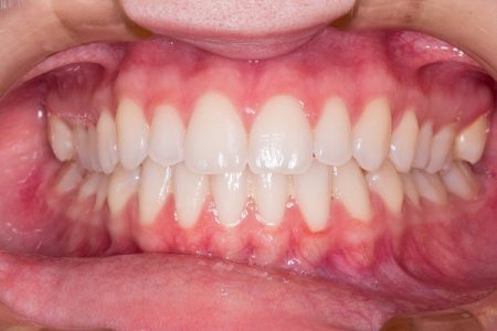 Impacted Tooth (Tooth Impaction): Causes, Symptoms, Treatment, Diagnosis