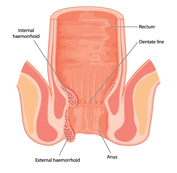 Hemorrhoids: What Do They Look Like?