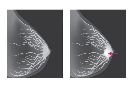 What Is a Mammogram?