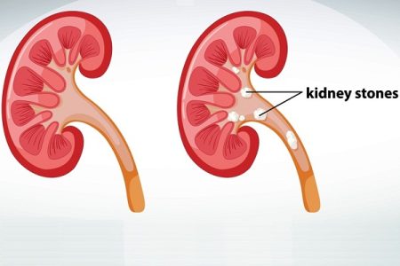 Passing a Kidney Stone