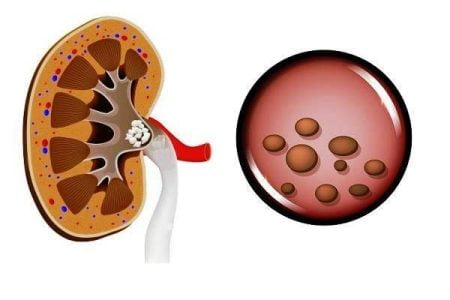 Uric Acid Kidney Stones