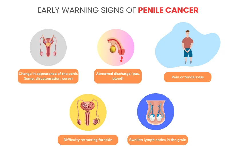 Penile cancer early-stage