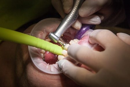 Tooth Crown Procedure