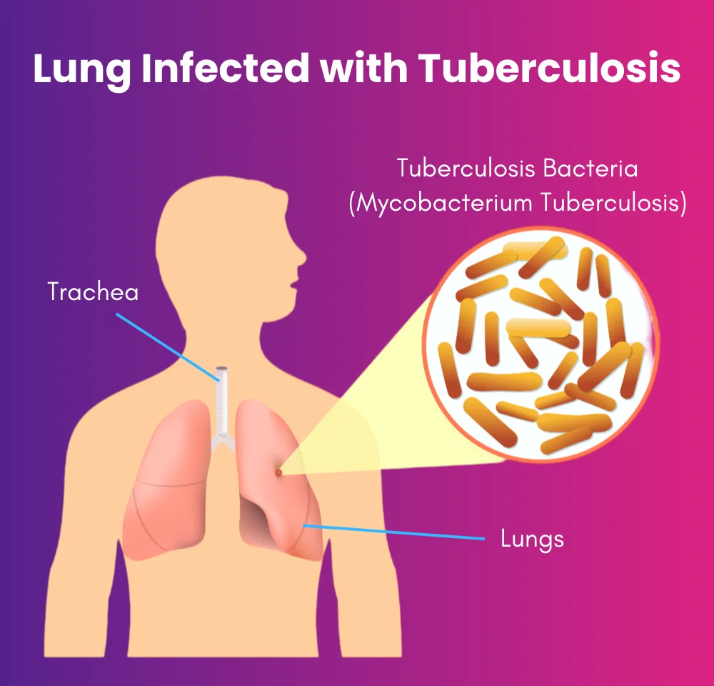 Lung Infected with Tuberculosis