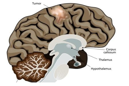 What is brain cancer (brain tumor)