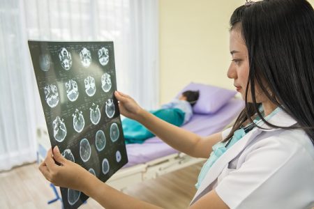 Brain Injury Increases Your Chances of Getting Stroke