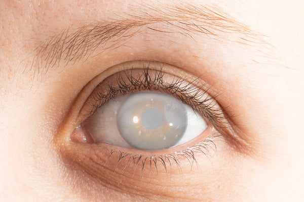 Cataract: Causes and Risk Factors