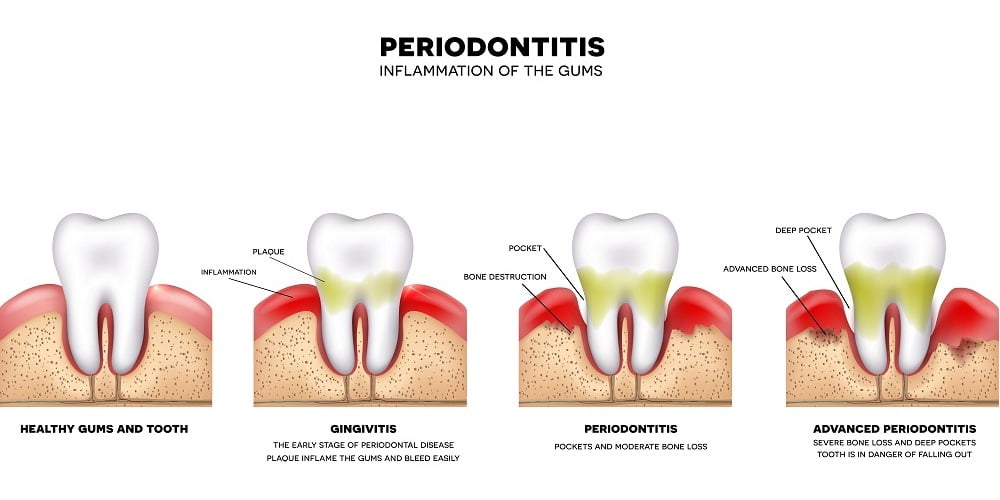 What causes gum disease?