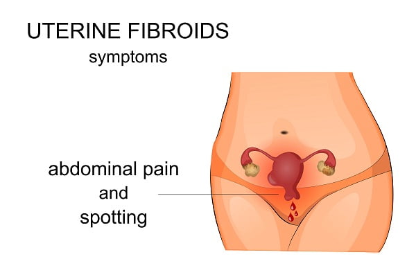 Uterine Fibroids Complications Signs And Symptoms Diseasefix