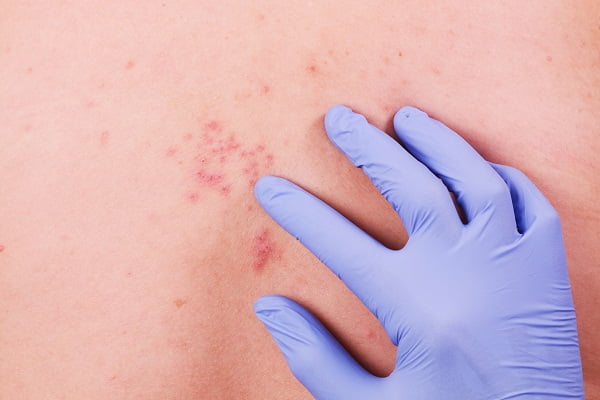 Diagnosis of Shingles