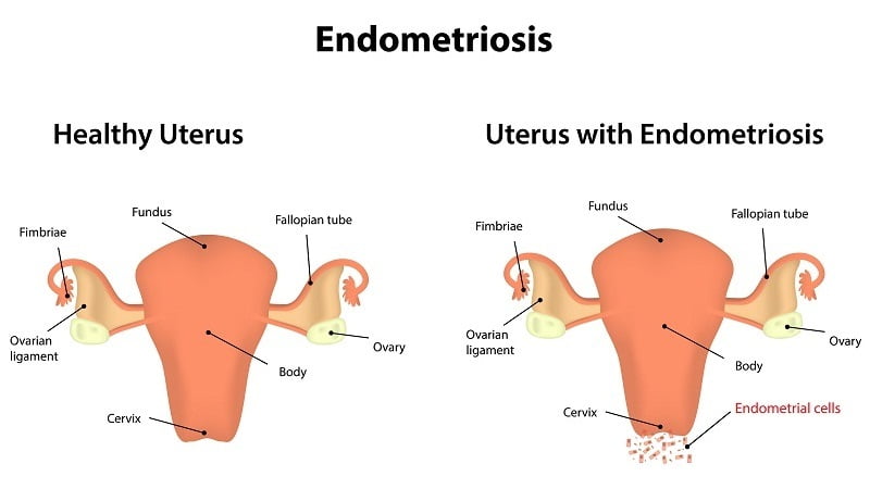 What Is Endometriosis