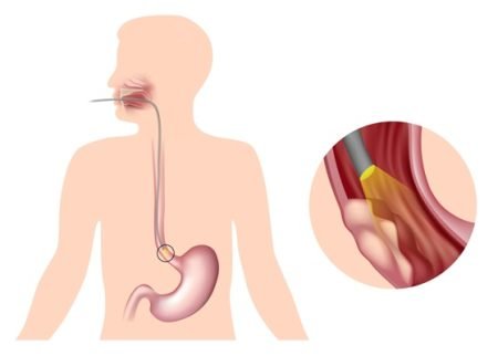 What is esophageal cancer – Definition and overview