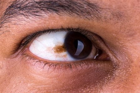Eye Cancer (Ocular Cancer)