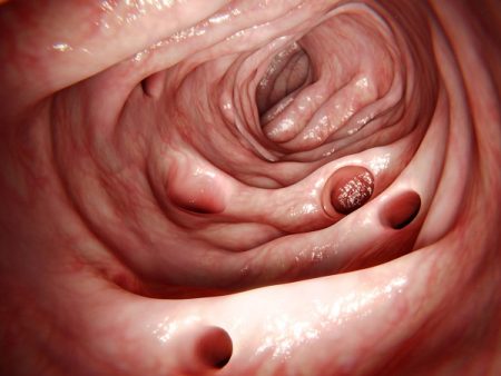 An Overview of Diverticulitis