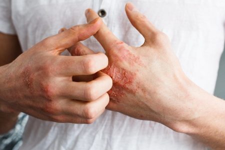 An Overview of Eczema