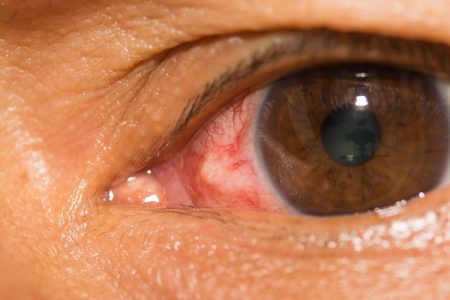 Symptoms Leading to Complications in Conjunctivitis Patients