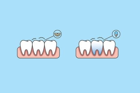 Why Are My Teeth Sensitive All of a Sudden?