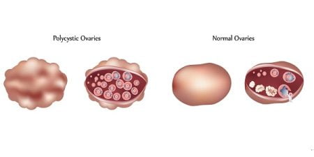 What Causes PCOS (Polycystic Ovary Syndrome)?