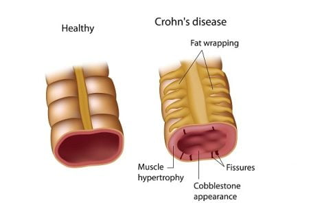 Crohn’s Disease: Causes, Symptoms, Diagnosis, Treatment, Complications
