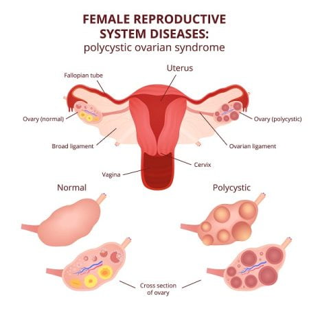 What is PCOS (Polycystic Ovary Syndrome)