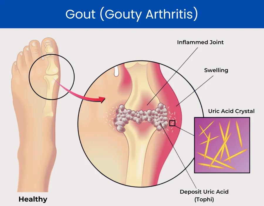 Gout