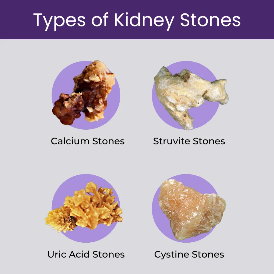 Types of Kidney Stones