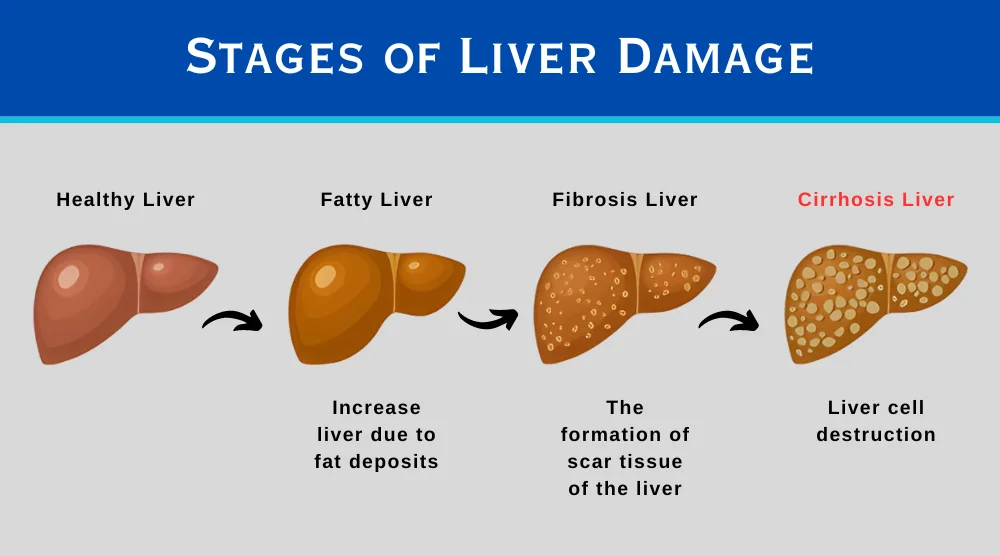 Liver Cirrhosis