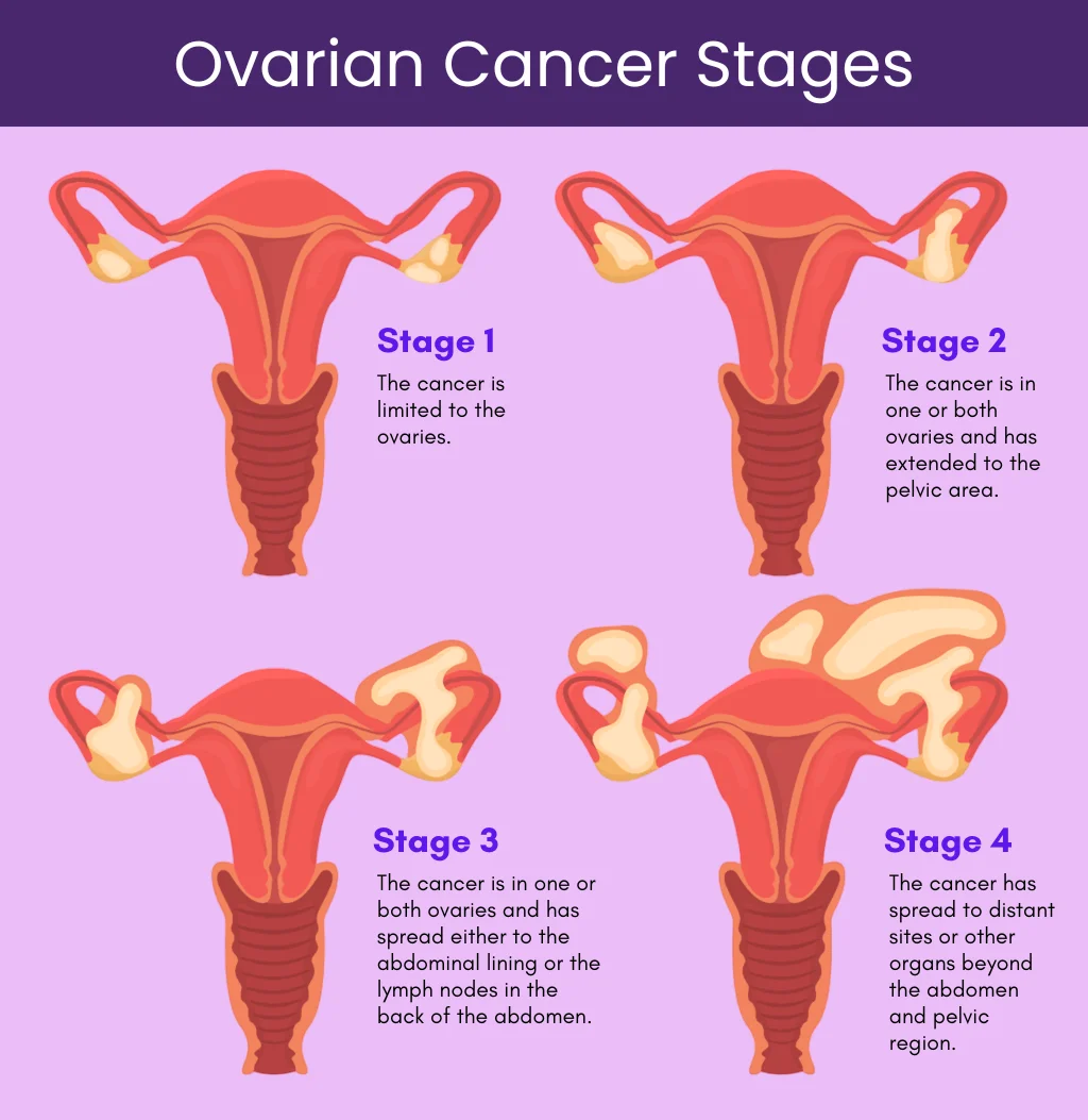 Ovarian Cancer Stages