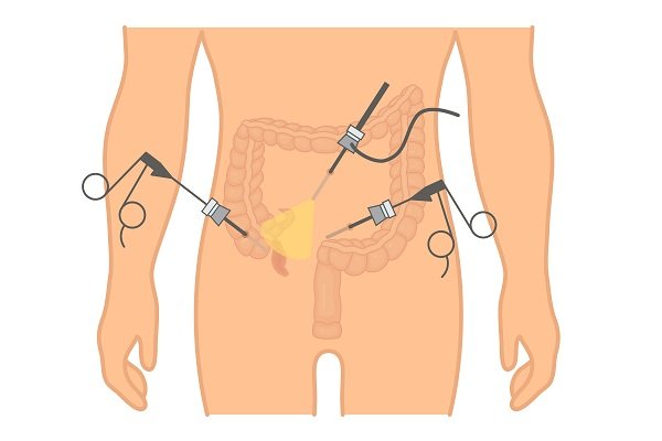 Appendicitis Tests