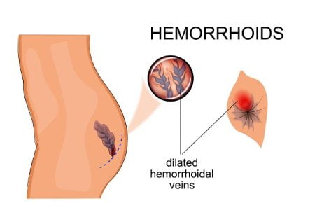 What Are the Causes and Risk Factors of Hemorrhoids?