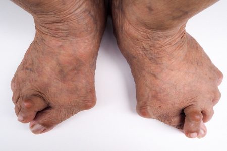Most Common Places For Gout: Where Do You Get Gout?