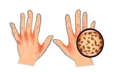 What Is Crusted Scabies (Norwegian Scabies)