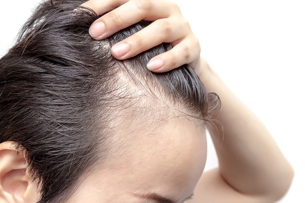 Is Dandruff Hereditary or Hormonal?