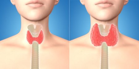 How to Diagnose Overactive Thyroid (Hyperthyroidism)?