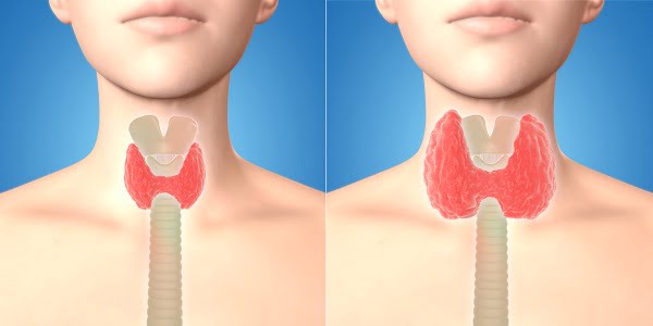 How to Diagnose Overactive Thyroid (Hyperthyroidism)?