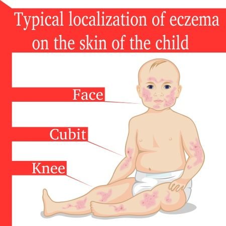 What Are the Symptoms of Eczema?