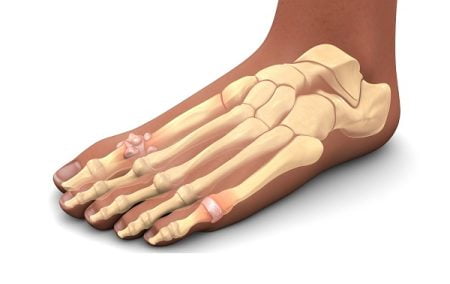 All You Need to Know About Gout