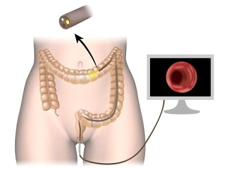 How are Hemorrhoids Diagnosed?