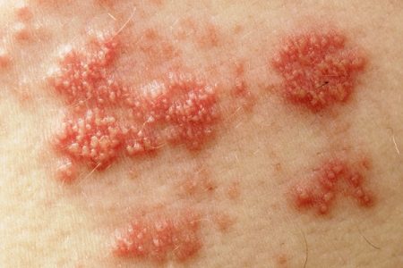 Shingles: Causes, Pain, Duration & Complications