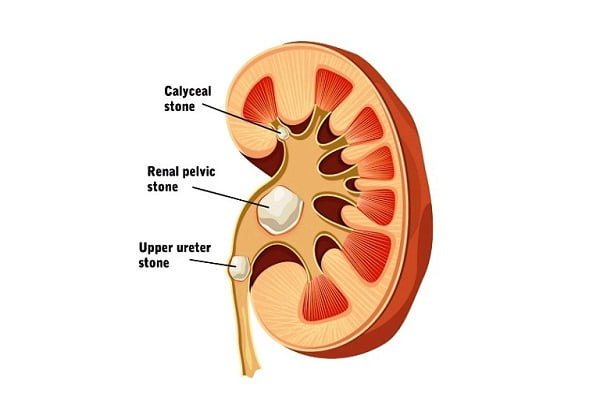 what do kidney stones look like in the toilet