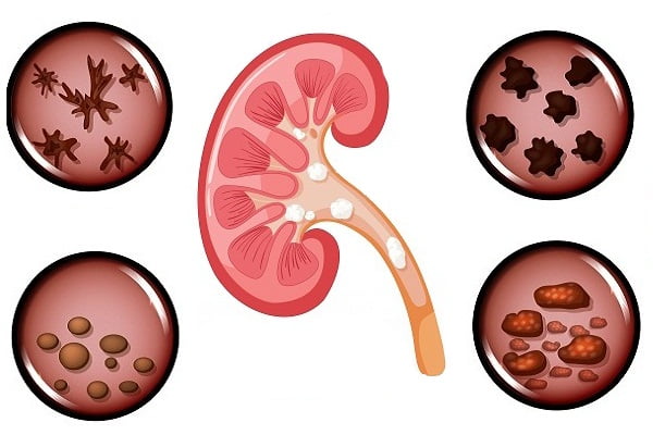 Types of Kidney Stones